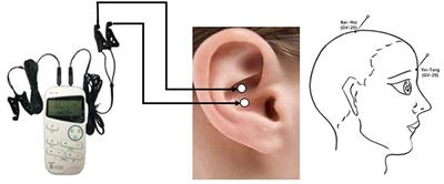 An assessor-blinded, randomized comparative trial of transcutaneous auricular vagus nerve stimulation (taVNS) combined with cranial electroacupuncture vs. citalopram for depression with chronic pain